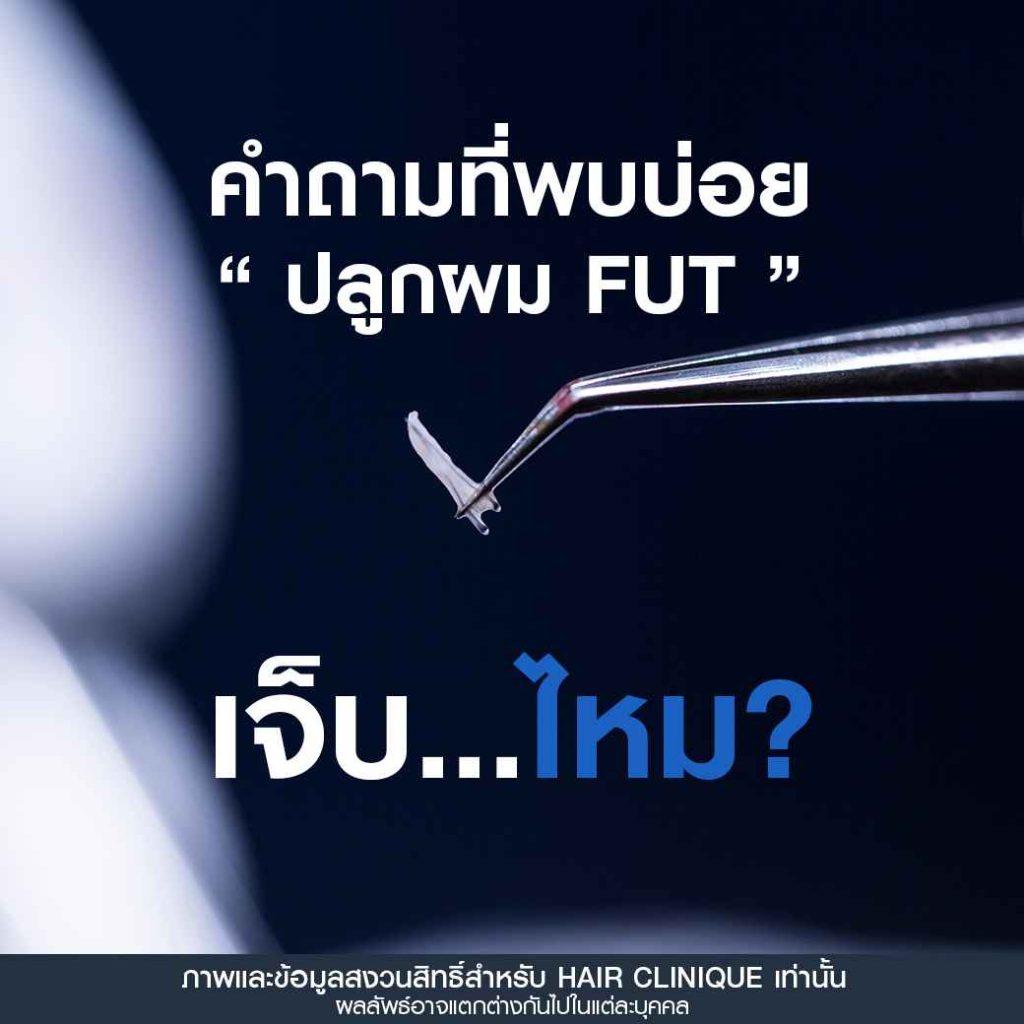 คำถามที่พบบ่อย FUT
