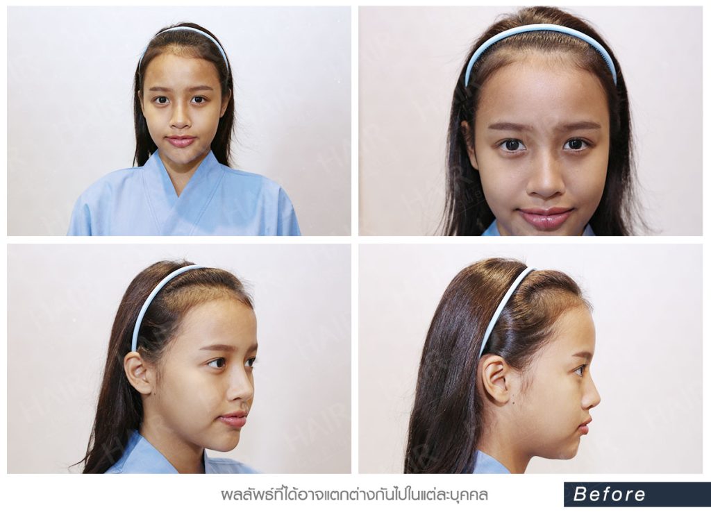 ก่อนปลูกผม-ปลูกผม-ปลูกผมผู้หญิง-เนย