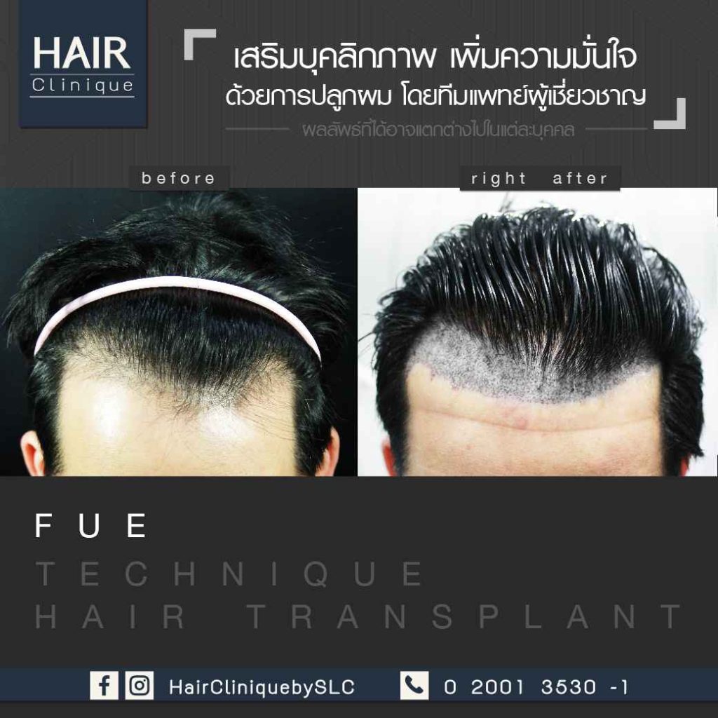 รีวิวปลูกผม FUE