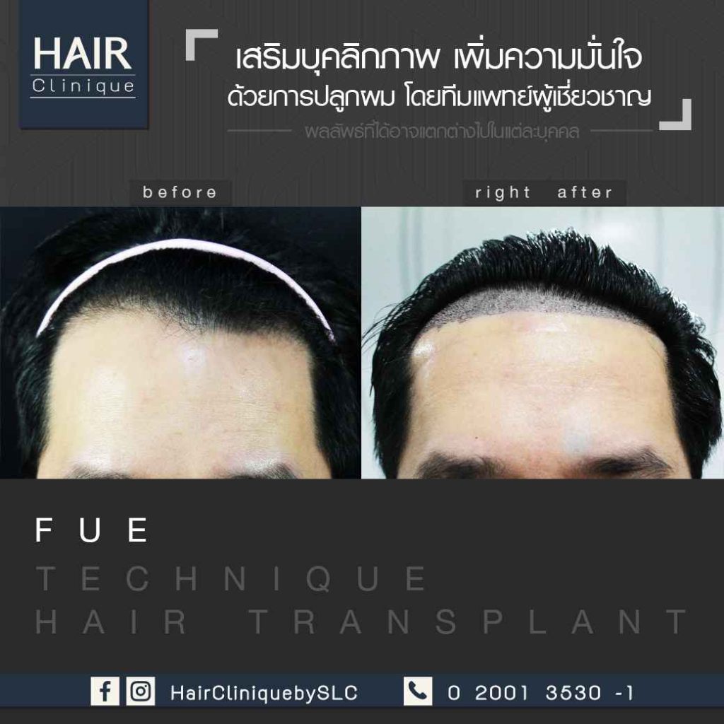 รีวิวปลูกผม FUE