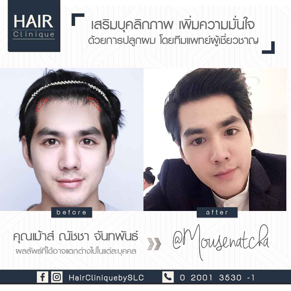 รีวิวปลูกผม FUE