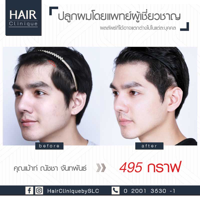 รีวิวปลูกผม FUE