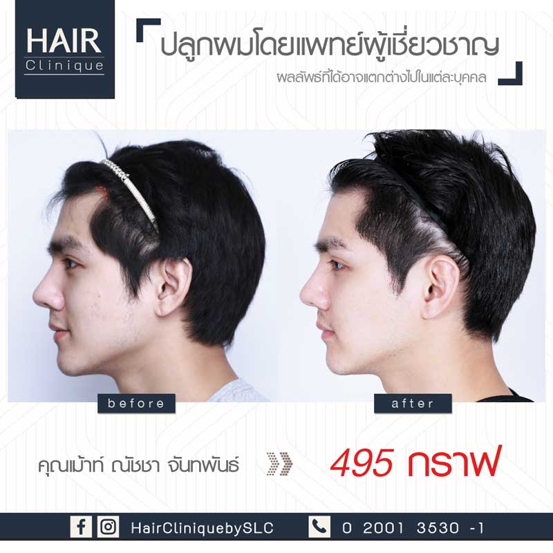 รีวิวปลูกผม FUE