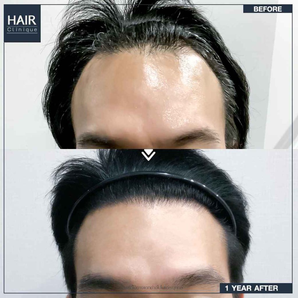 รีวิวปลูกผม FUT