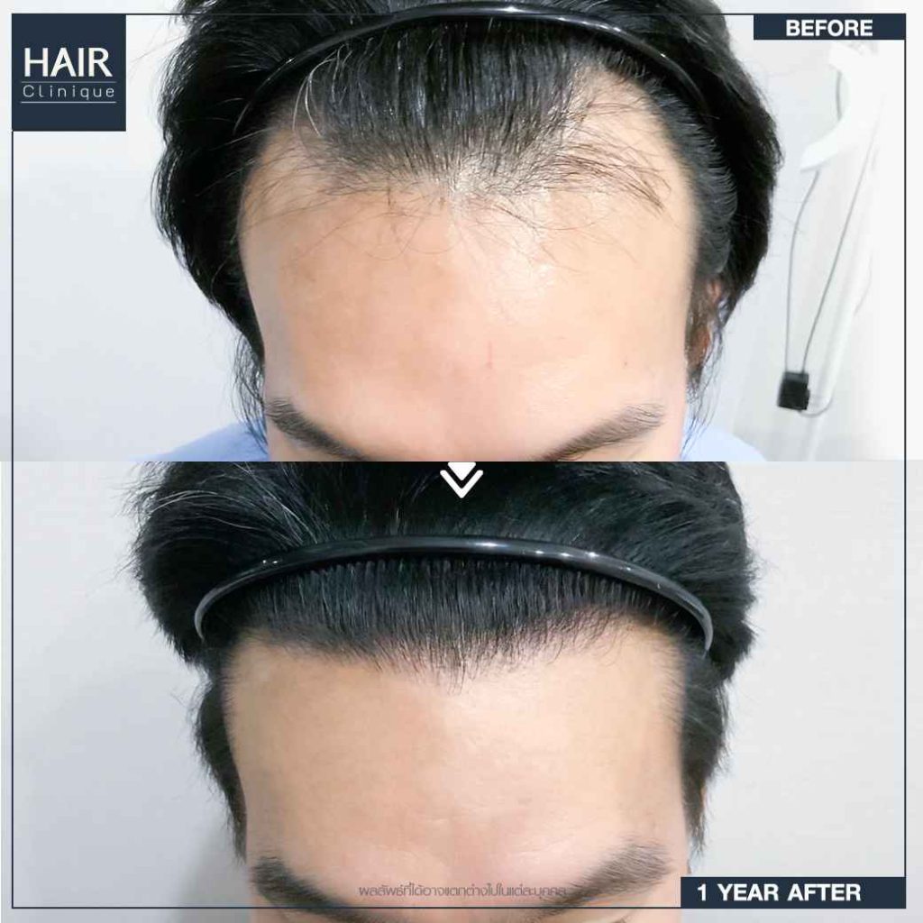 รีวิวปลูกผม FUT