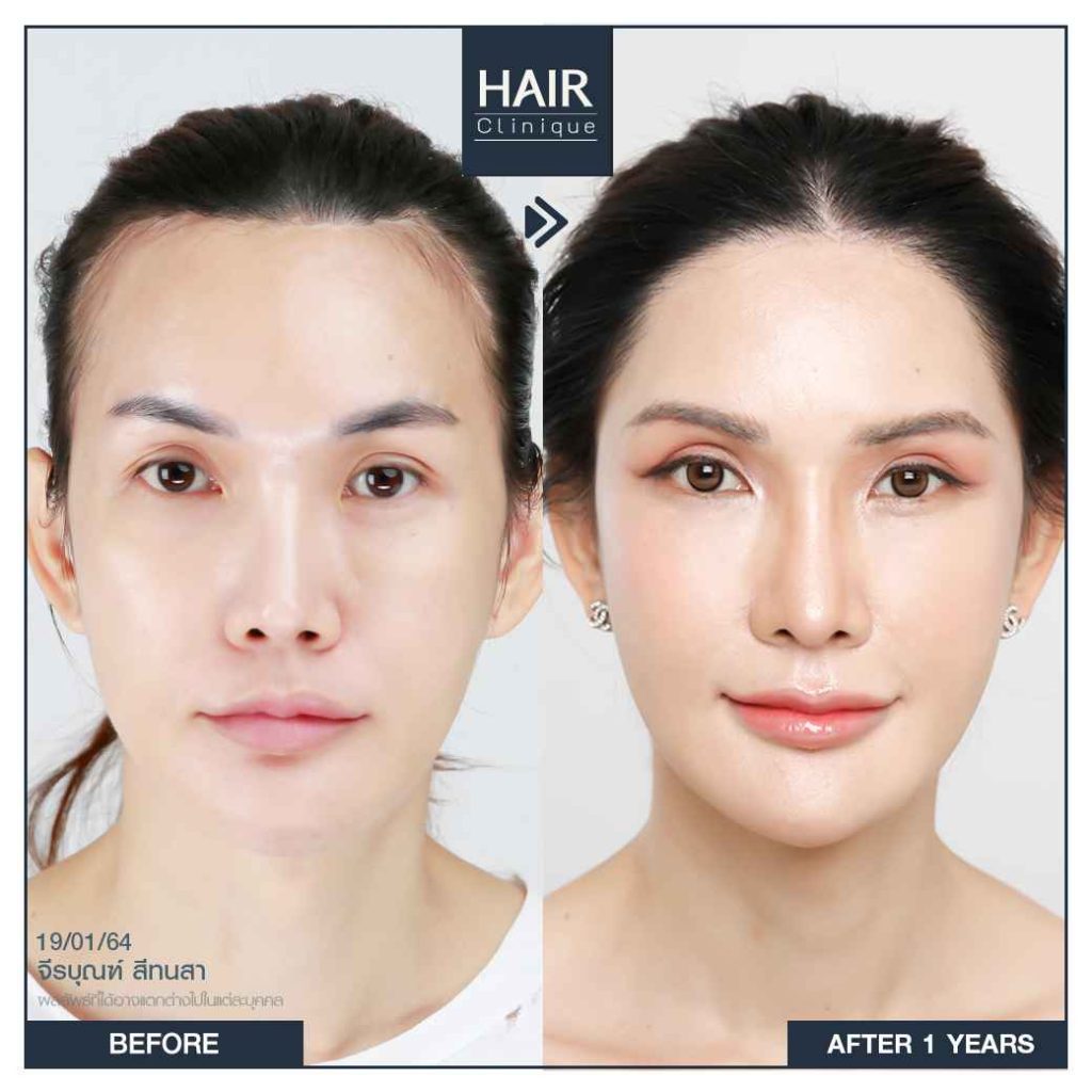 รีวิวปลูกผม FUT