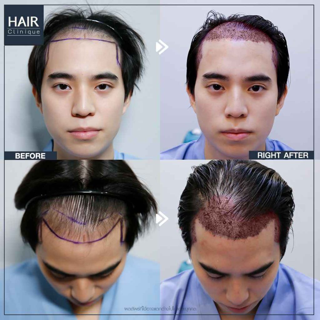 รีวิวปลูกผม FUT