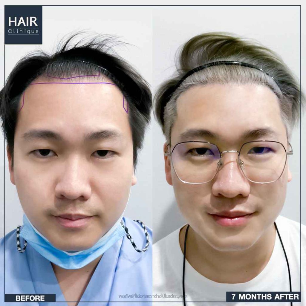 รีวิวปลูกผม FUT