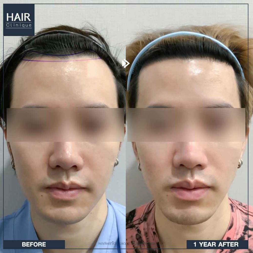 รีวิวปลูกผม FUT