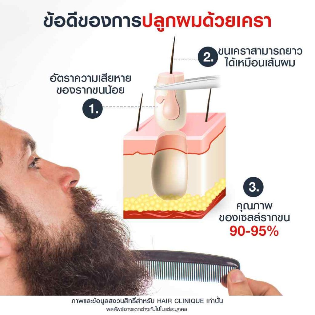 เพิ่มความหนาแน่นด้วยการปลูกผมด้วยขนเครา