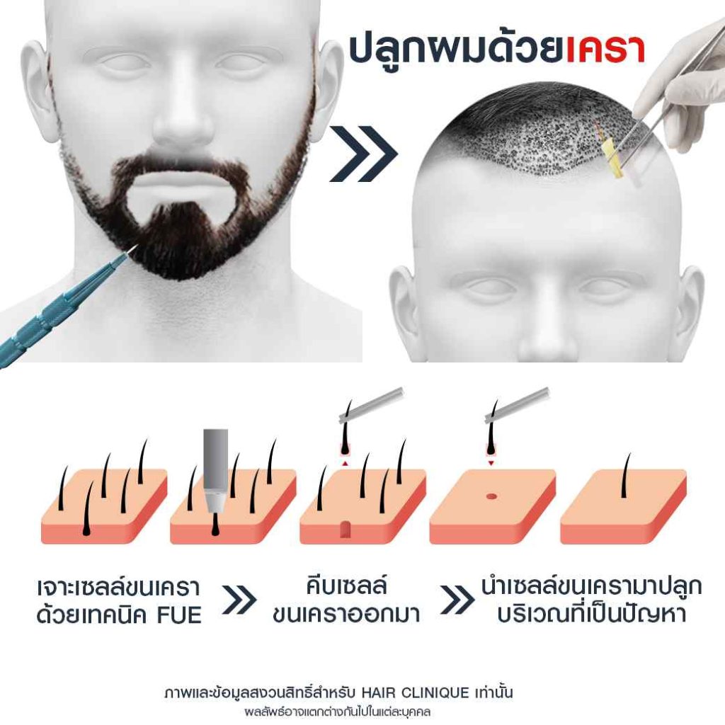 รู้หรือไม่? ปลูกผมด้วยขนเคราได้