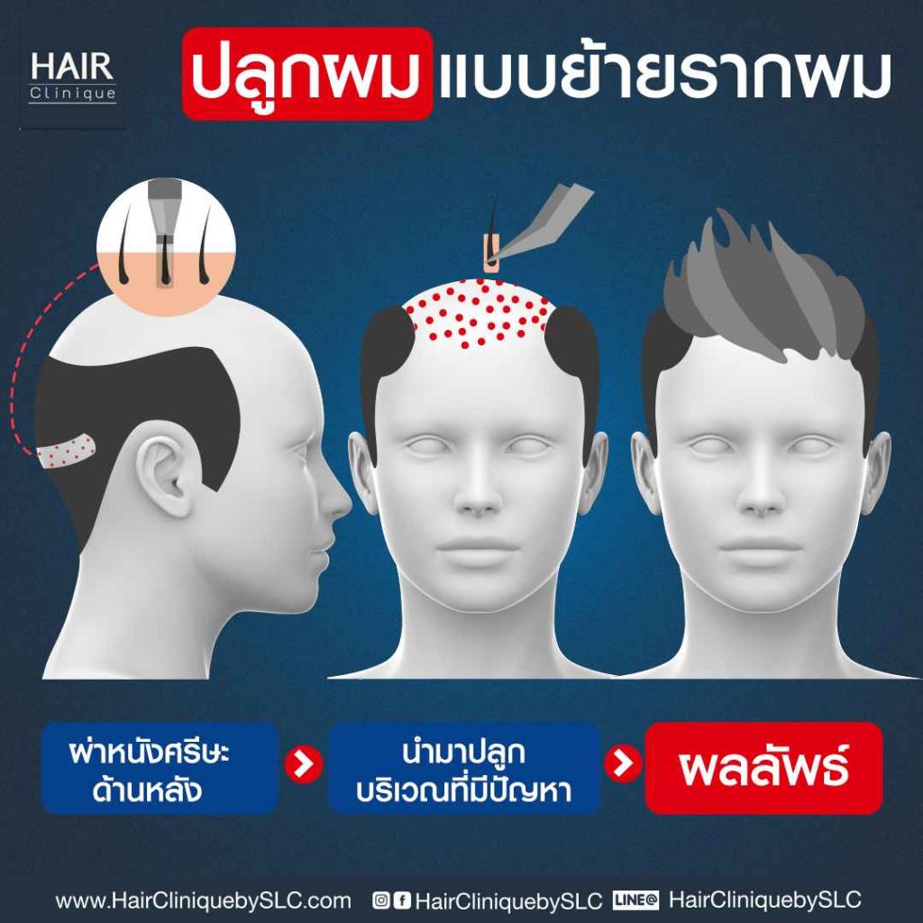 ปลูกผมแบบย้ายรากผม (ปลูกผม FUT)