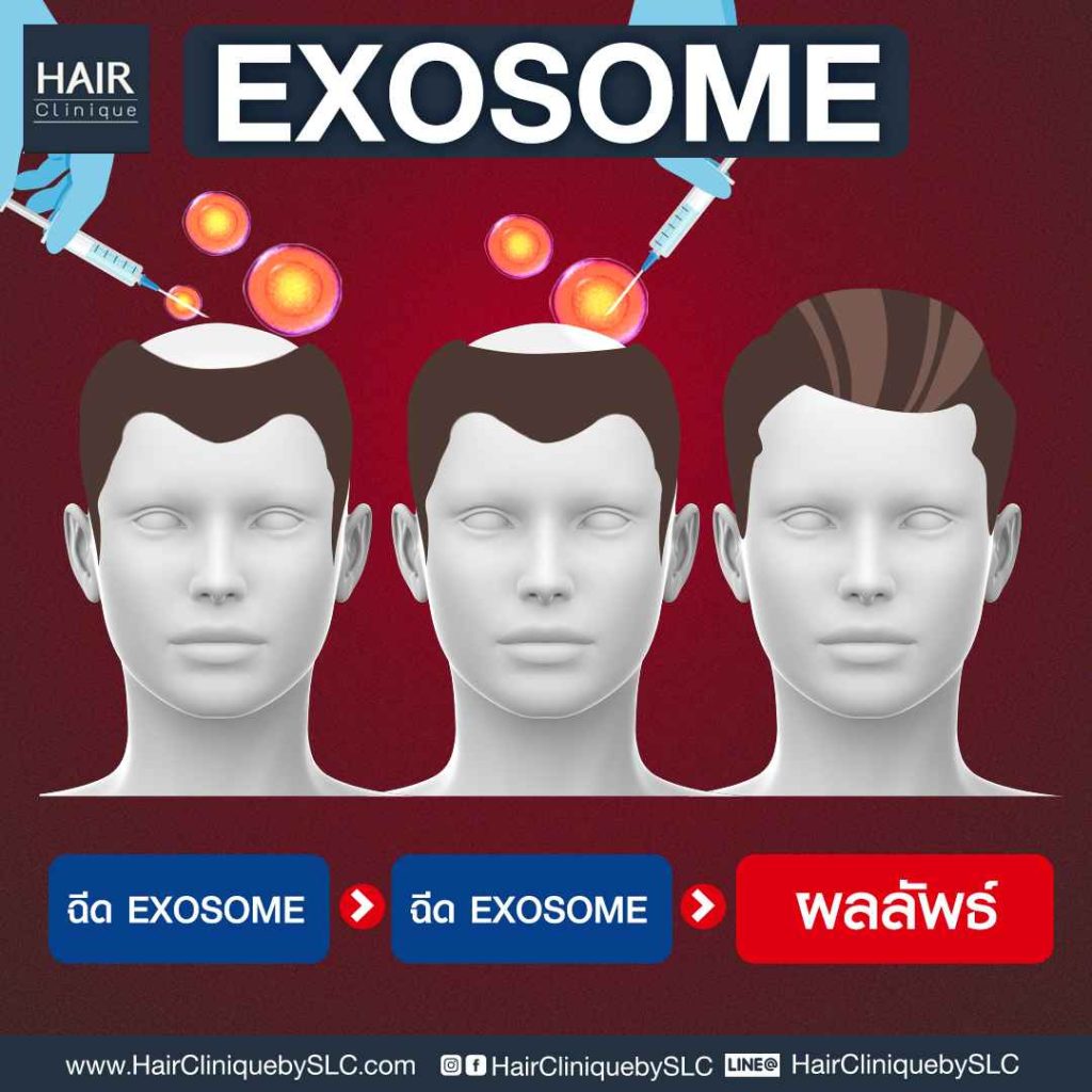 ปลูกผมแบบฉีด (ฉีด Exosome) 