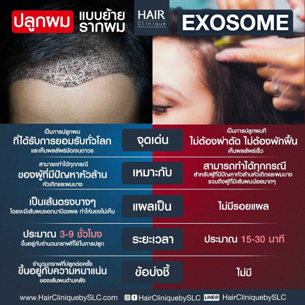 ปลูกผมแบบย้ายรากผม vs ปลูกผมแบบฉีด