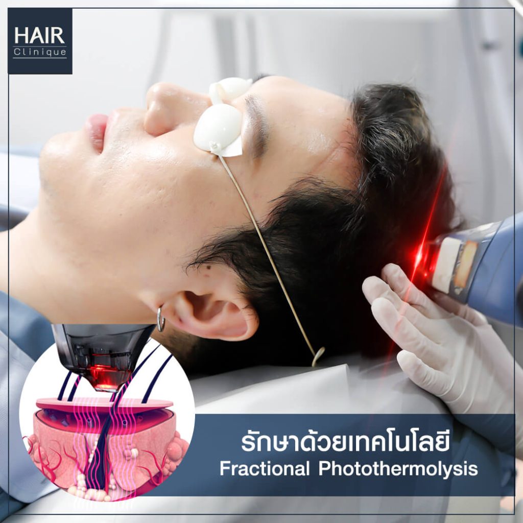 รีวิว Hair Fraxel เลเซอร์รักษาผมร่วง