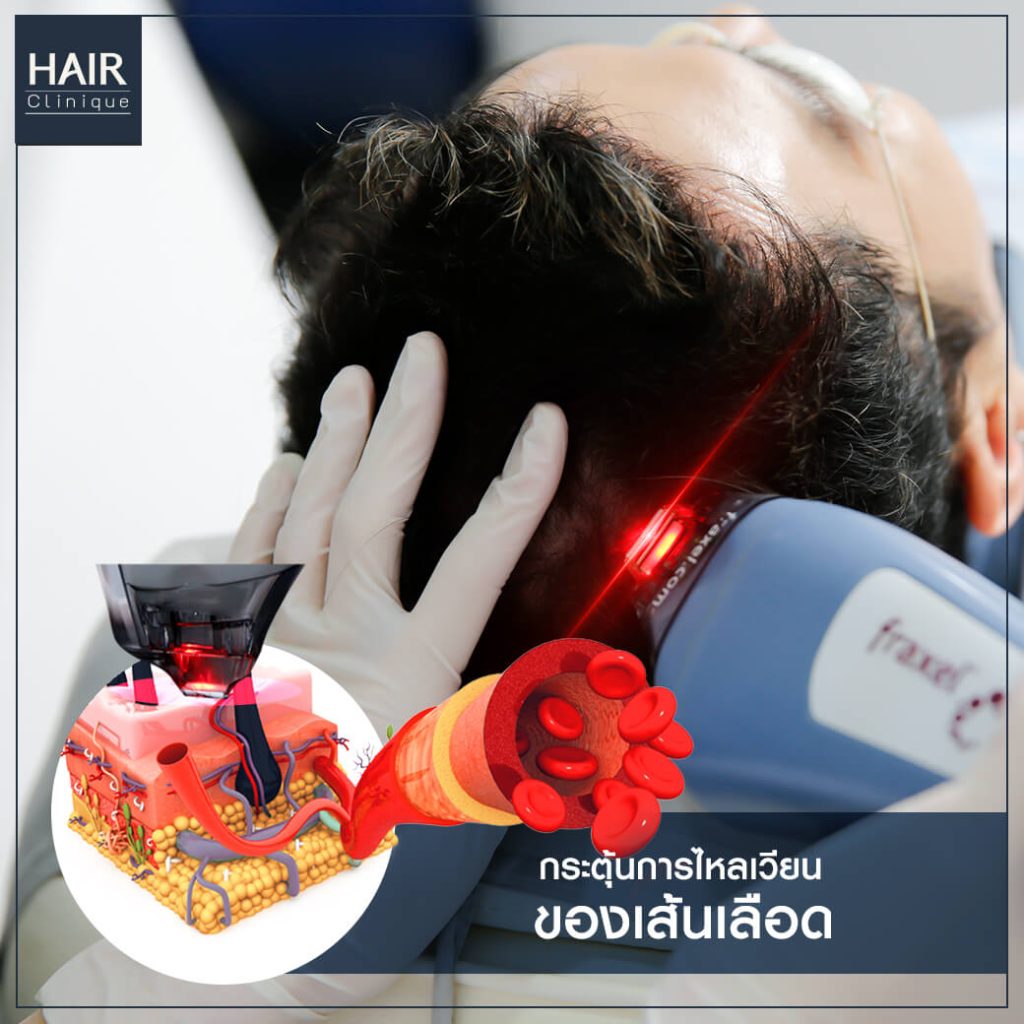 รีวิว Hair Fraxel เลเซอร์รักษาผมร่วง