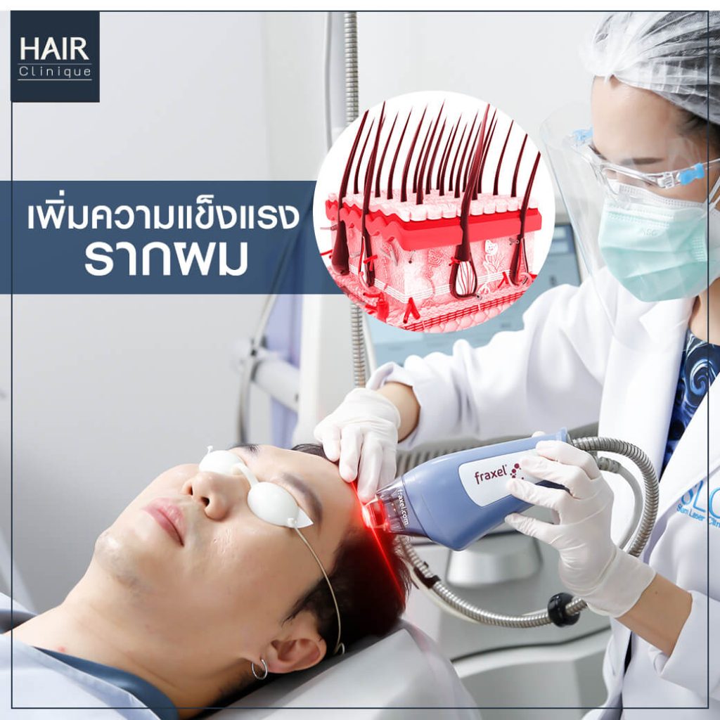รีวิว Hair Fraxel เลเซอร์รักษาผมร่วง