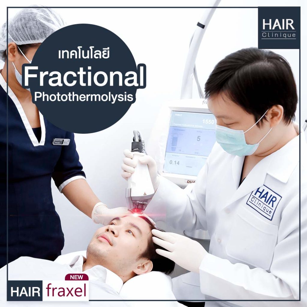 รีวิว Hair Fraxel เลเซอร์รักษาผมร่วง