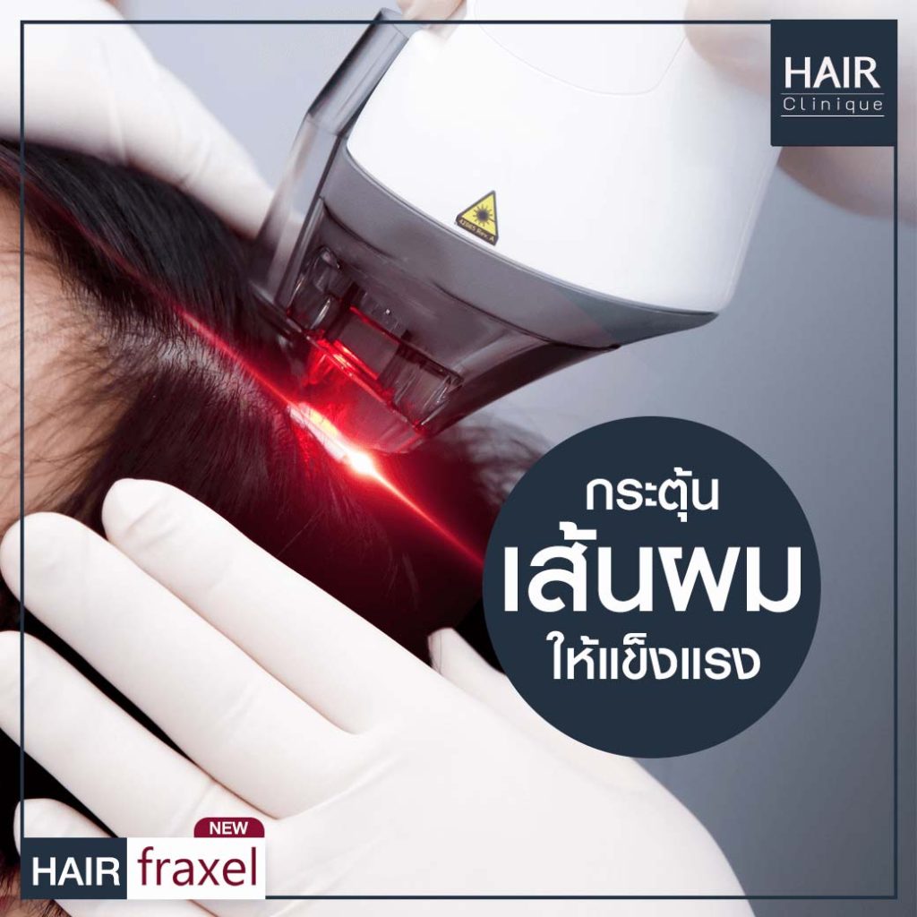 รีวิว Hair Fraxel เลเซอร์รักษาผมร่วง