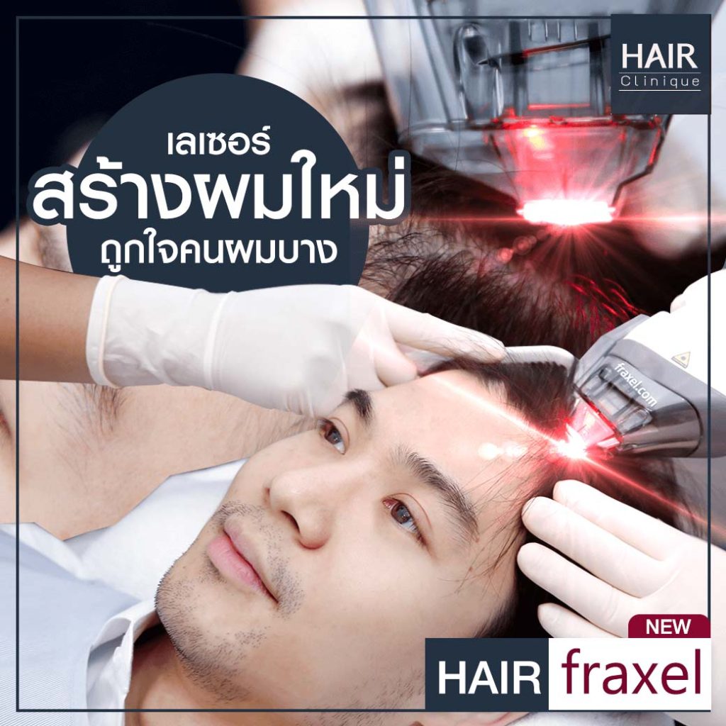 รีวิว Hair Fraxel เลเซอร์รักษาผมร่วง