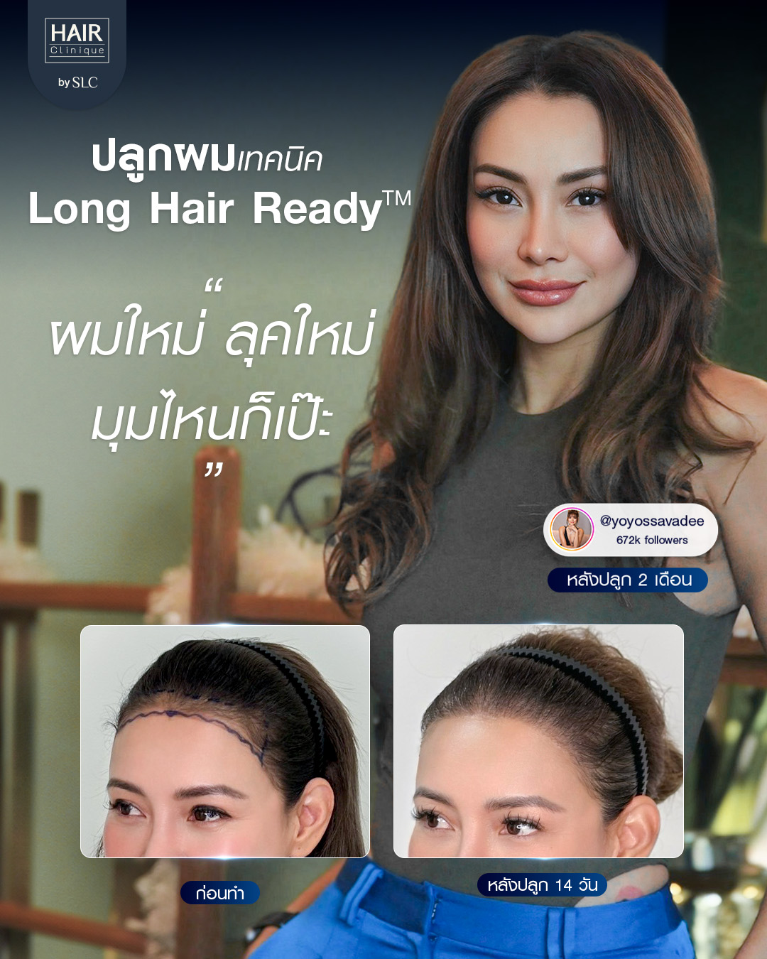 ดาราปลูกผม, ปลูกผมถาวร, ดาราผมบาง, เทคนิคปลูกผม, ปลูกผมที่ SLC, คนดังปลูกผม, โย ยศวดี