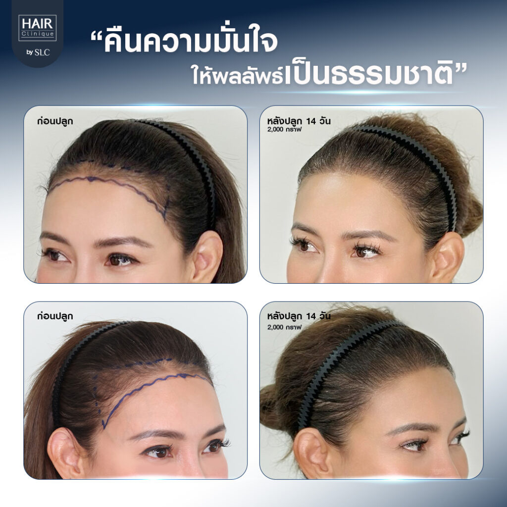 ดาราปลูกผม, ปลูกผมถาวร, ดาราผมบาง, เทคนิคปลูกผม, ปลูกผมที่ SLC, คนดังปลูกผม, โย ยศวดี