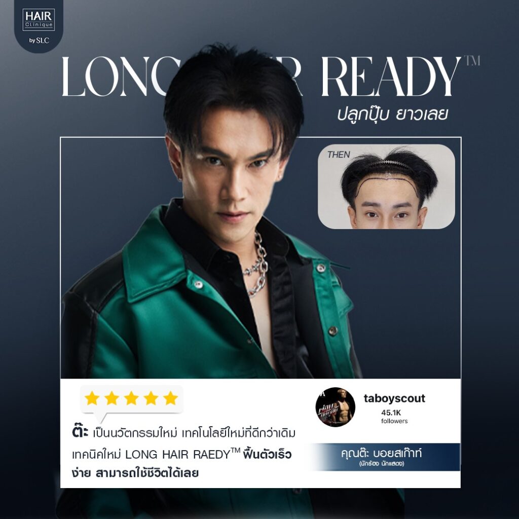 พี่ต๊ะ บอยสเก๊าท์, ดาราปลูกผม, ปลูกผมถาวร, ดาราผมบาง, เทคนิคปลูกผม, ปลูกผมที่ SLC, คนดังปลูกผม