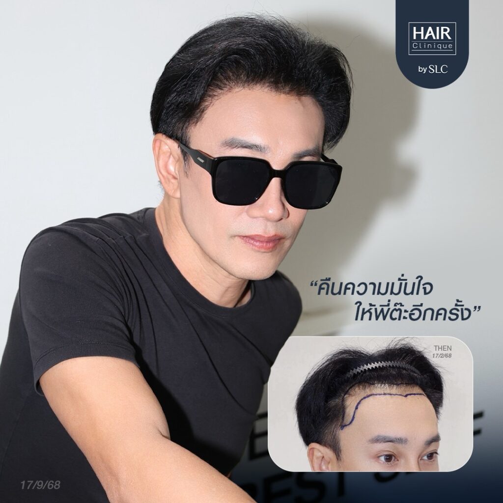 พี่ต๊ะ บอยสเก๊าท์, ดาราปลูกผม, ปลูกผมถาวร, ดาราผมบาง, เทคนิคปลูกผม, ปลูกผมที่ SLC, คนดังปลูกผม