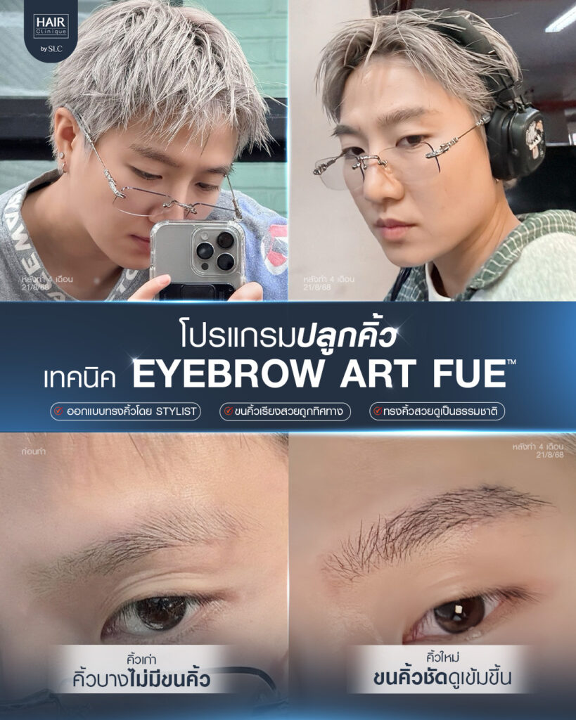 ปลูกคิ้วผู้ชาย, ปลูกคิ้วราคา, ปลูกคิ้วธรรมชาติ, ปลูกคิ้วดีไหม, ปลูกคิ้วที่ไหนดี