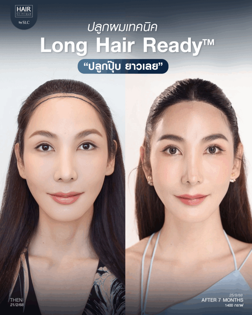 พอร์ช Miss Tiffany’s ปลูกผม, ปลูกผม Long Hair Ready™, มิสทิฟฟานี่, ปรับกรอบหน้า, ปรับกรอบหน้า, หน้าหวานละมุน