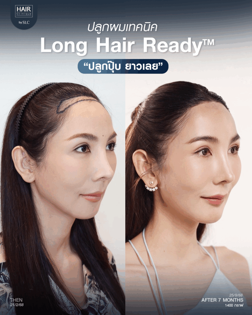 พอร์ช Miss Tiffany’s ปลูกผม, ปลูกผม Long Hair Ready™, มิสทิฟฟานี่, ปรับกรอบหน้า, ปรับกรอบหน้า, หน้าหวานละมุน