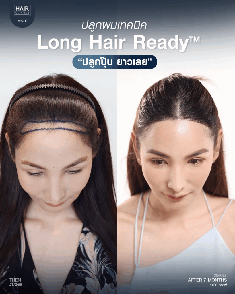 พอร์ช Miss Tiffany’s ปลูกผม, ปลูกผม Long Hair Ready™, มิสทิฟฟานี่, ปรับกรอบหน้า, ปรับกรอบหน้า, หน้าหวานละมุน