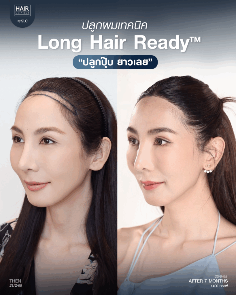 พอร์ช Miss Tiffany’s ปลูกผม, ปลูกผม Long Hair Ready™, มิสทิฟฟานี่, ปรับกรอบหน้า, ปรับกรอบหน้า, หน้าหวานละมุน