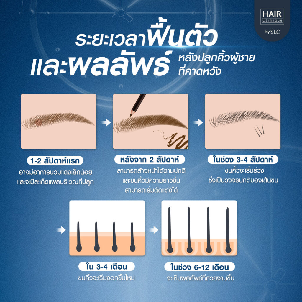 ปลูกคิ้วผู้ชาย, ปลูกคิ้วราคา, ปลูกคิ้วธรรมชาติ, ปลูกคิ้วดีไหม, ปลูกคิ้วที่ไหนดี