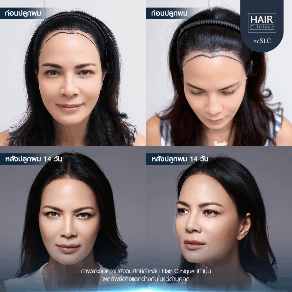 พิม ซอนย่า ปลูกผม, ปลูกผมเทคนิค Long Hair Ready™, ดาราปลูกผมที่ไหน, หัวเถิก, กรอบหน้าชัด