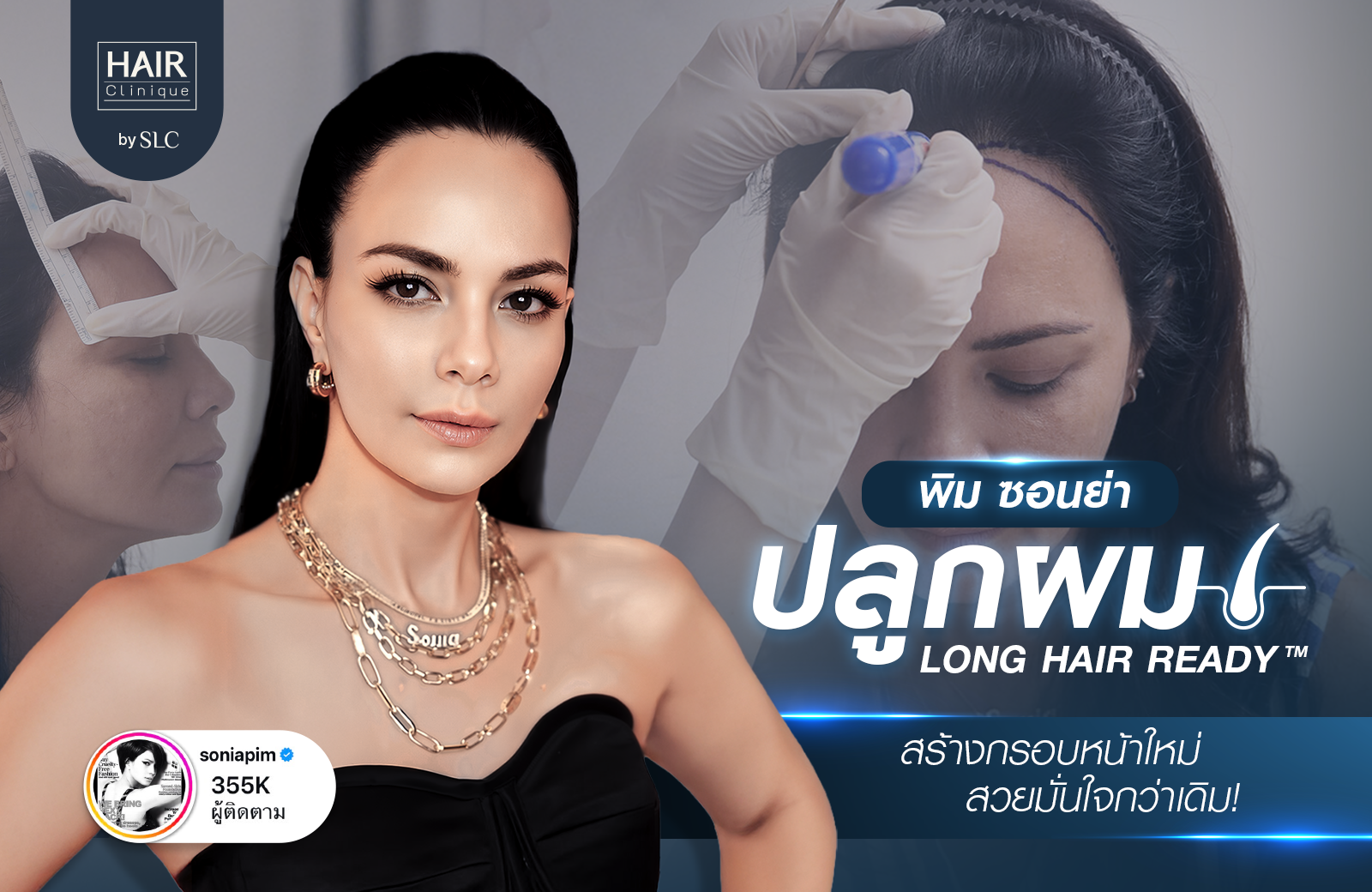 พิม ซอนย่า ปลูกผม, ปลูกผมเทคนิค Long Hair Ready™, ดาราปลูกผมที่ไหน, หัวเถิก, กรอบหน้าชัด