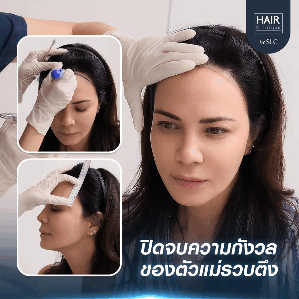 พิม ซอนย่า ปลูกผม, ปลูกผมเทคนิค Long Hair Ready™, ดาราปลูกผมที่ไหน, หัวเถิก, กรอบหน้าชัด