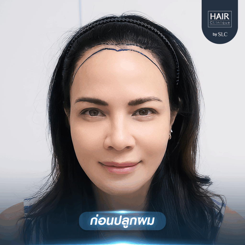 พิม ซอนย่า ปลูกผม, ปลูกผมเทคนิค Long Hair Ready™, ดาราปลูกผมที่ไหน, หัวเถิก, กรอบหน้าชัด