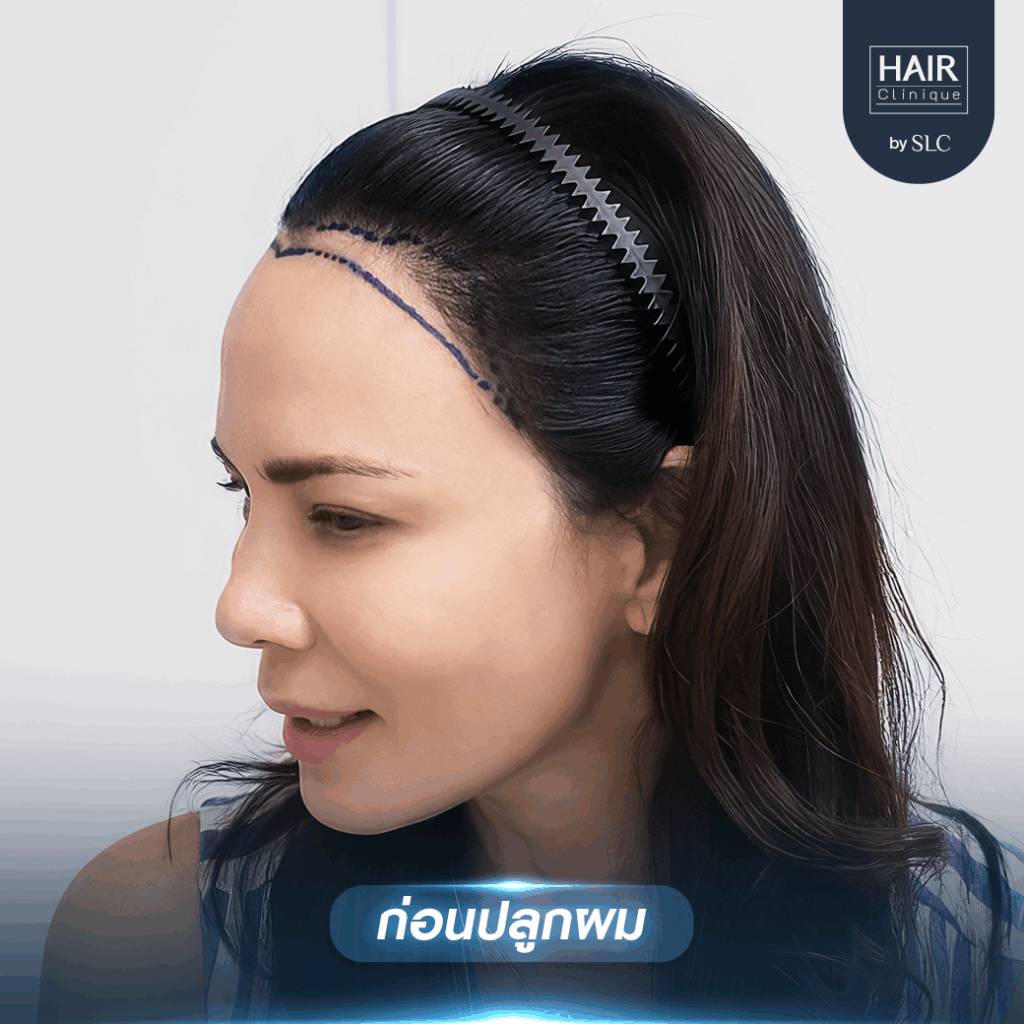 พิม ซอนย่า ปลูกผม, ปลูกผมเทคนิค Long Hair Ready™, ดาราปลูกผมที่ไหน, หัวเถิก, กรอบหน้าชัด