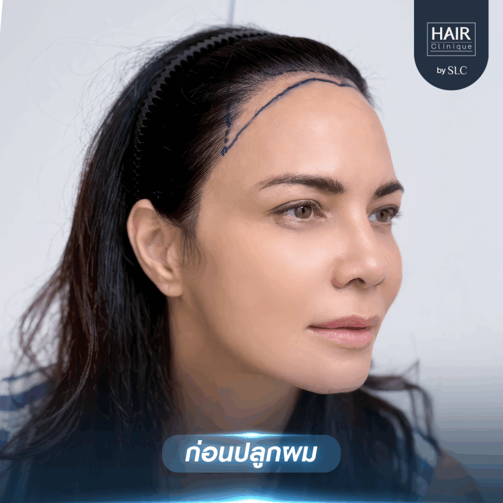 พิม ซอนย่า ปลูกผม, ปลูกผมเทคนิค Long Hair Ready™, ดาราปลูกผมที่ไหน, หัวเถิก, กรอบหน้าชัด