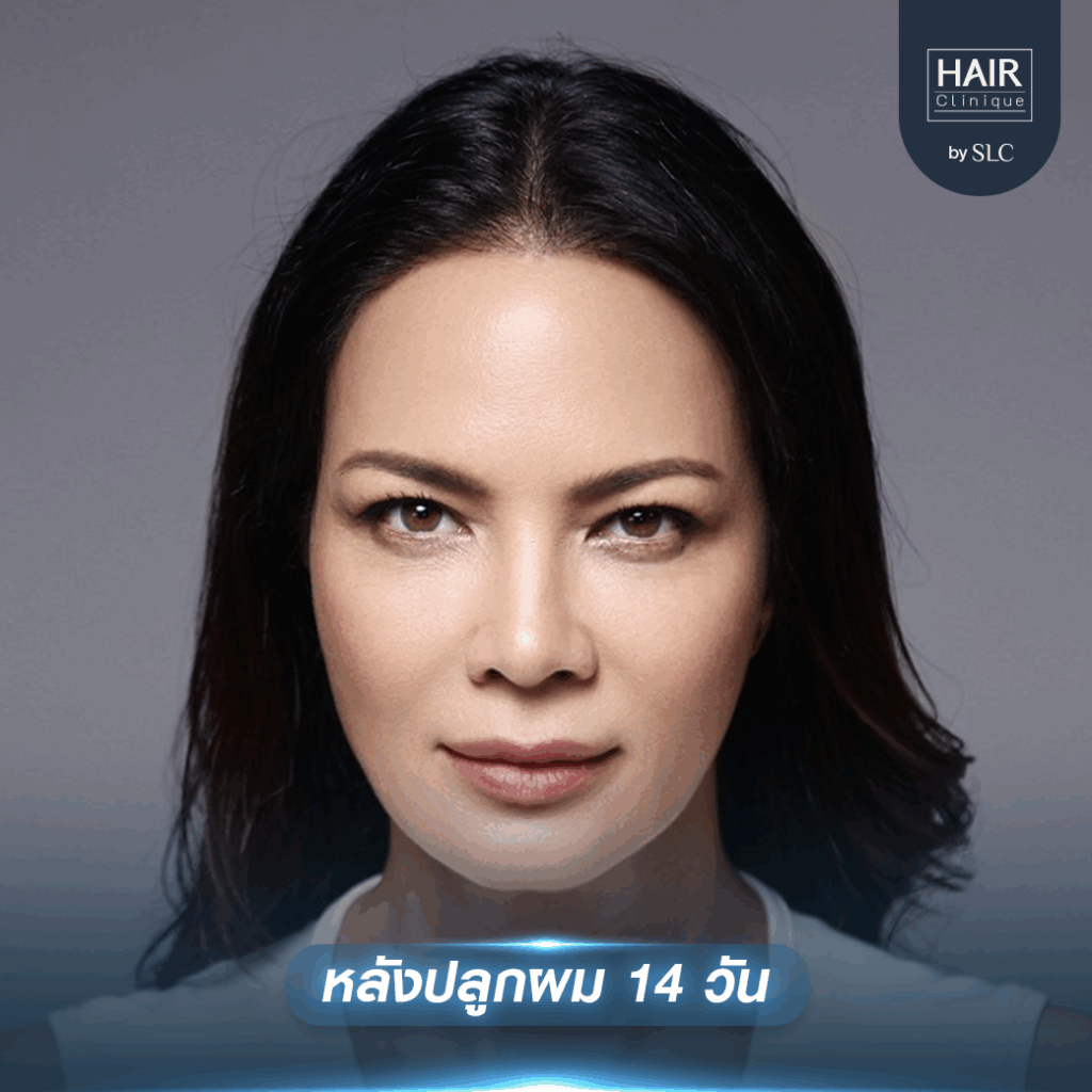 พิม ซอนย่า ปลูกผม, ปลูกผมเทคนิค Long Hair Ready™, ดาราปลูกผมที่ไหน, หัวเถิก, กรอบหน้าชัด
