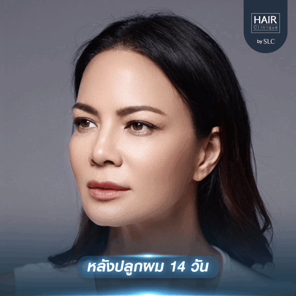 พิม ซอนย่า ปลูกผม, ปลูกผมเทคนิค Long Hair Ready™, ดาราปลูกผมที่ไหน, หัวเถิก, กรอบหน้าชัด