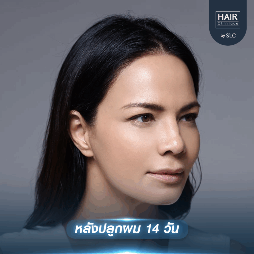 พิม ซอนย่า ปลูกผม, ปลูกผมเทคนิค Long Hair Ready™, ดาราปลูกผมที่ไหน, หัวเถิก, กรอบหน้าชัด