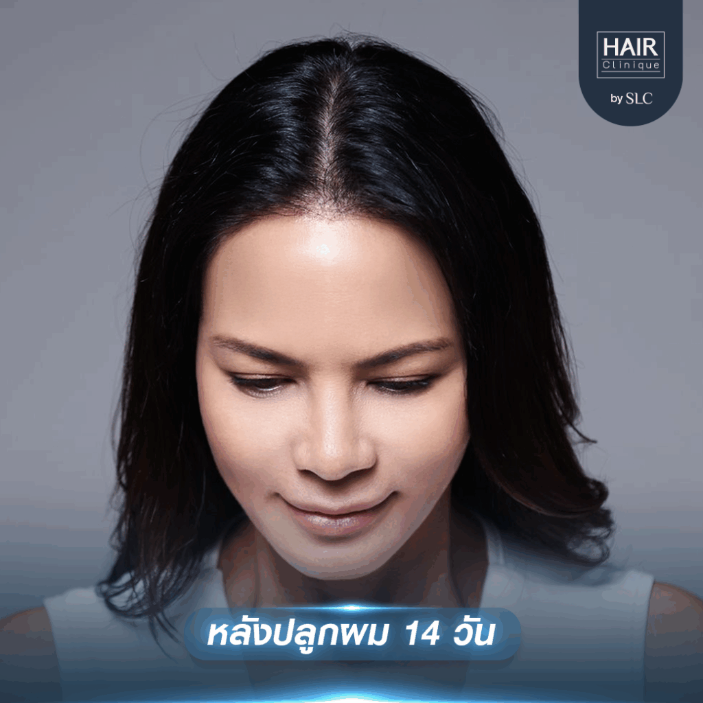 พิม ซอนย่า ปลูกผม, ปลูกผมเทคนิค Long Hair Ready™, ดาราปลูกผมที่ไหน, หัวเถิก, กรอบหน้าชัด