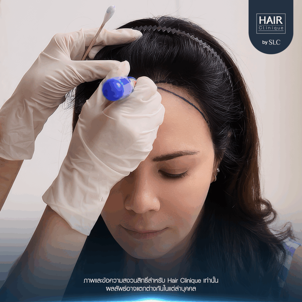 พิม ซอนย่า ปลูกผม, ปลูกผมเทคนิค Long Hair Ready™, ดาราปลูกผมที่ไหน, หัวเถิก, กรอบหน้าชัด