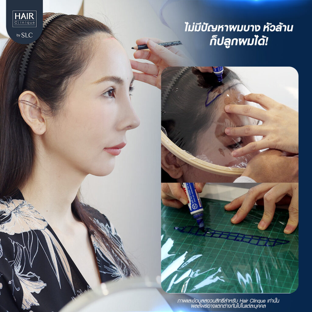 พอร์ช Miss Tiffany’s ปลูกผม, ปลูกผม Long Hair Ready™, มิสทิฟฟานี่, ปรับกรอบหน้า, ปรับกรอบหน้า, หน้าหวานละมุน