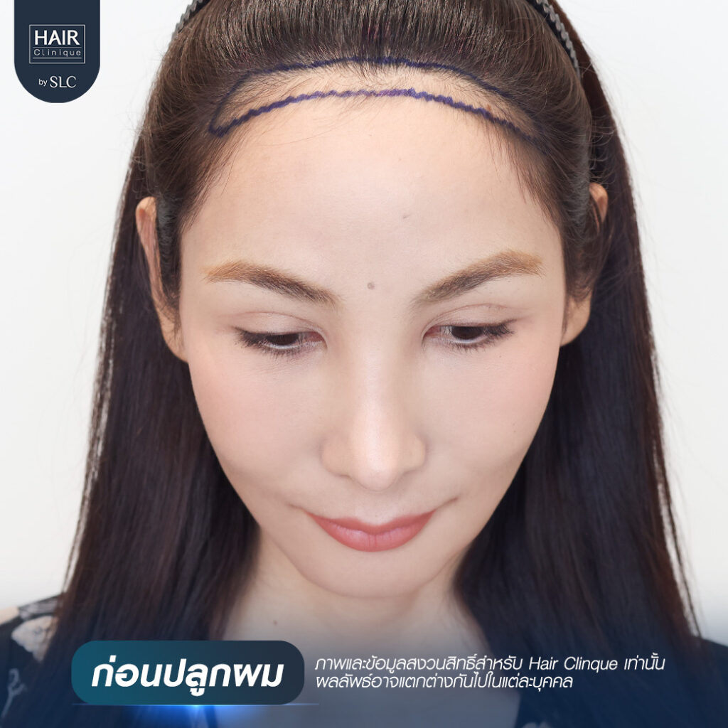 พอร์ช Miss Tiffany’s ปลูกผม, ปลูกผม Long Hair Ready™, มิสทิฟฟานี่, ปรับกรอบหน้า, ปรับกรอบหน้า, หน้าหวานละมุน