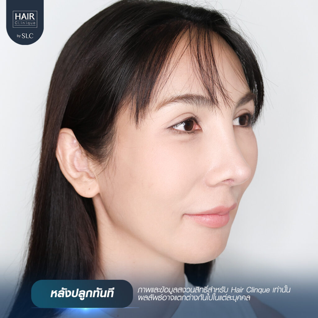 พอร์ช Miss Tiffany’s ปลูกผม, ปลูกผม Long Hair Ready™, มิสทิฟฟานี่, ปรับกรอบหน้า, ปรับกรอบหน้า, หน้าหวานละมุน