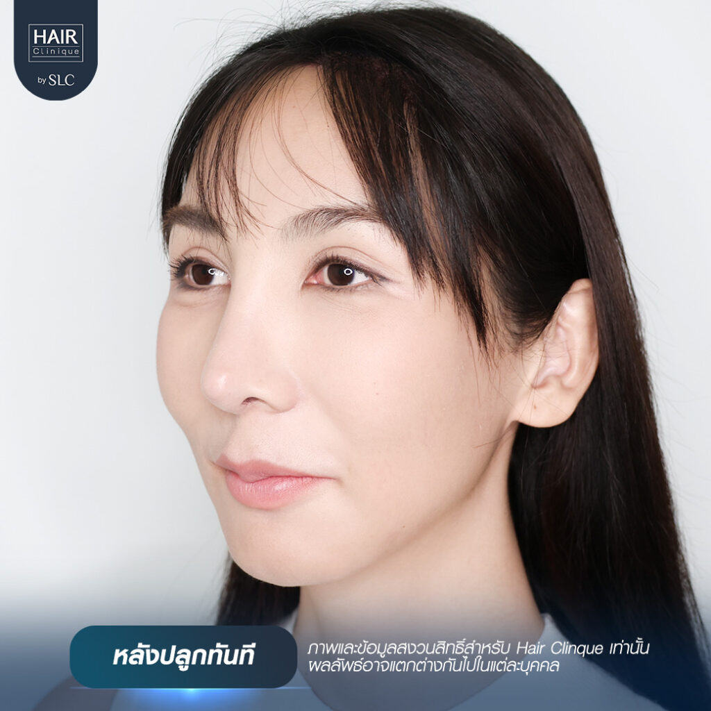 พอร์ช Miss Tiffany’s ปลูกผม, ปลูกผม Long Hair Ready™, มิสทิฟฟานี่, ปรับกรอบหน้า, ปรับกรอบหน้า, หน้าหวานละมุน