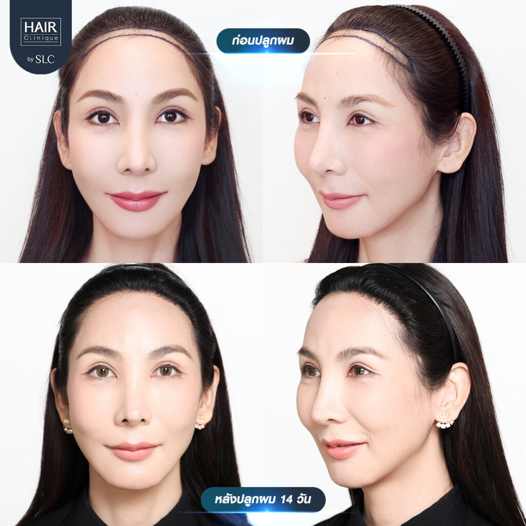 พอร์ช Miss Tiffany’s ปลูกผม, ปลูกผม Long Hair Ready™, มิสทิฟฟานี่, ปรับกรอบหน้า, ปรับกรอบหน้า, หน้าหวานละมุน